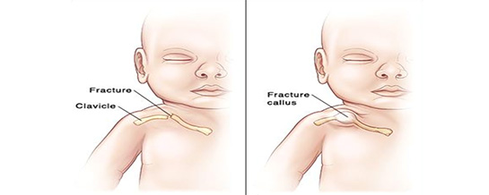 Clavicle Fracture