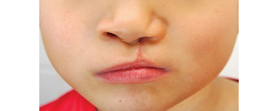 cleft lip