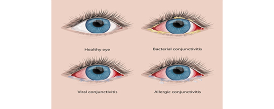 Conjunctivitis