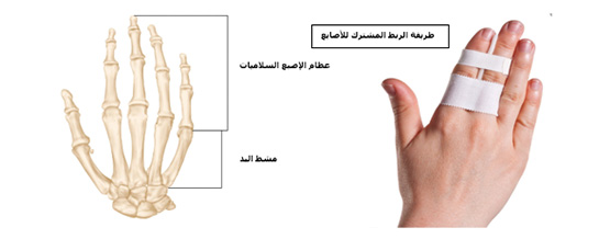 Finger Fracture