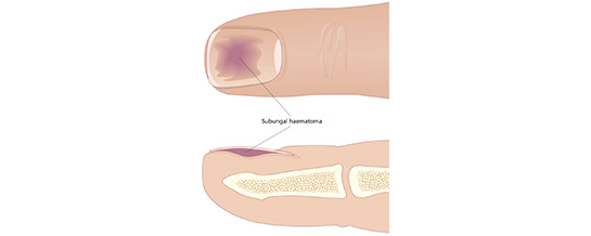 Hematoma