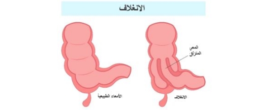 How to Care for Your Child with Intussusception