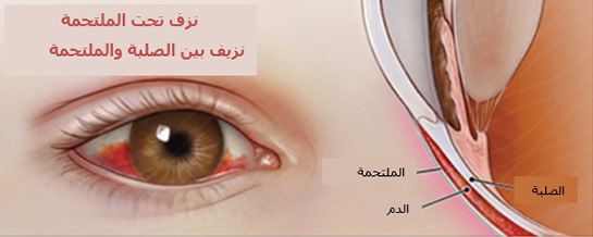 Subconjunctival Hemorrhage