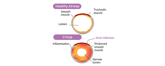 croup