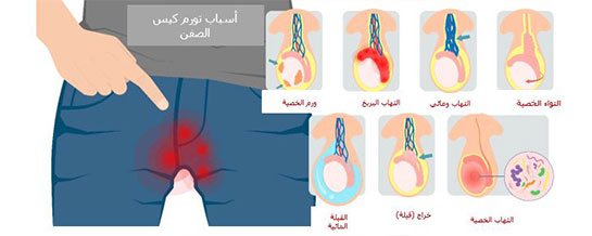 How to Care for Your Child with a scrotal swelling 